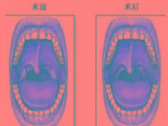 扁桃体周围脓肿
