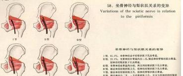 梨状肌综合征