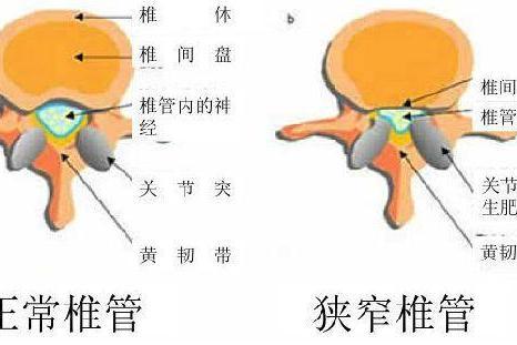 症 管 狭窄 腰部 看護 脊柱 頸部脊柱管狭窄症 (けいぶせきちゅうかんきょうさくしょう)