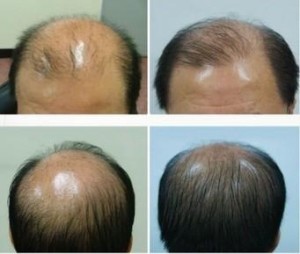 男性生发
