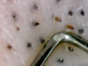 黑头粉刺 黑头粉刺