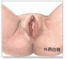 外阴白斑