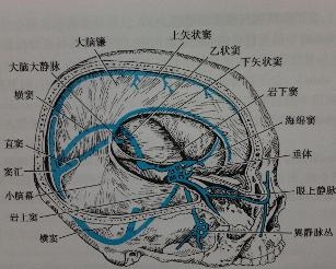 大腦大靜脈瘤