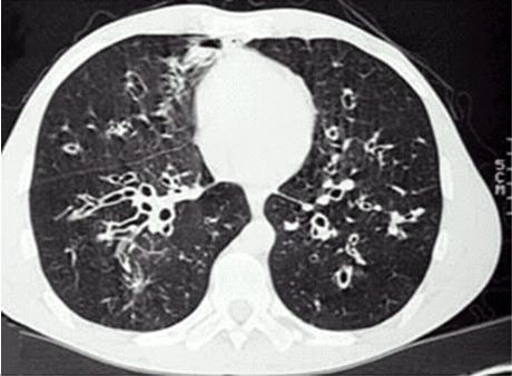 支气管扩张胸片图片