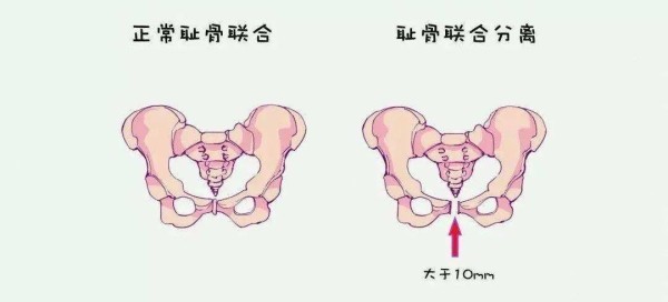 耻骨 髋骨的前下部 搜狗百科