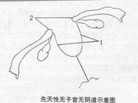 先天性无子宫