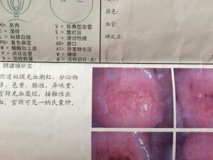 宫颈糜烂3度