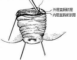 直肠粘膜脱垂的早期症状