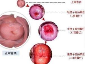宫颈糜烂3度