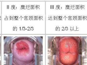 宫颈糜烂3度