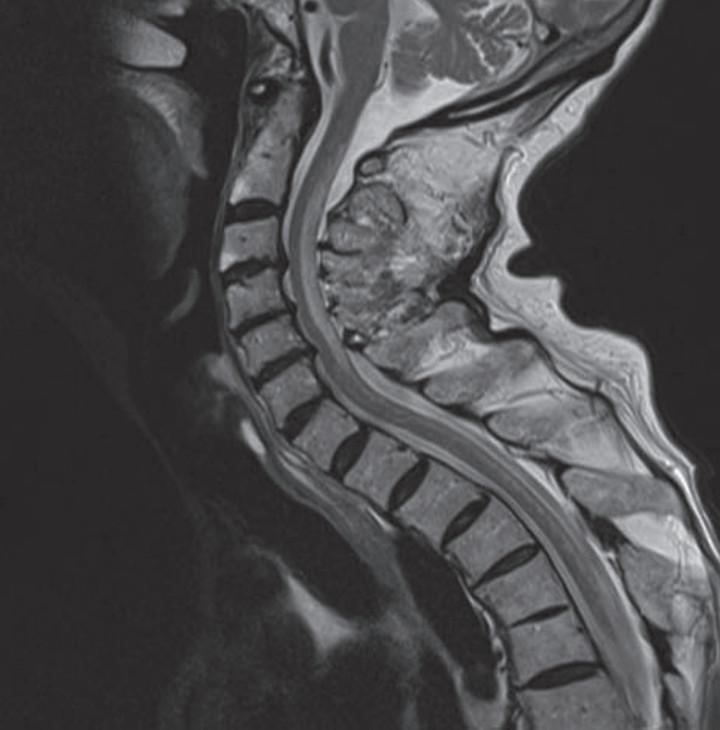 脊髓前联合图片