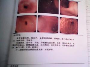 慢性浅表性胃炎