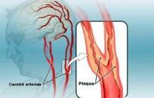 颈动脉斑块