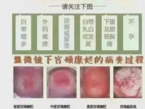 宫颈糜烂3度
