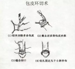 韩式环切手术图片
