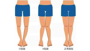 x形腿