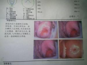 宫颈糜烂3度