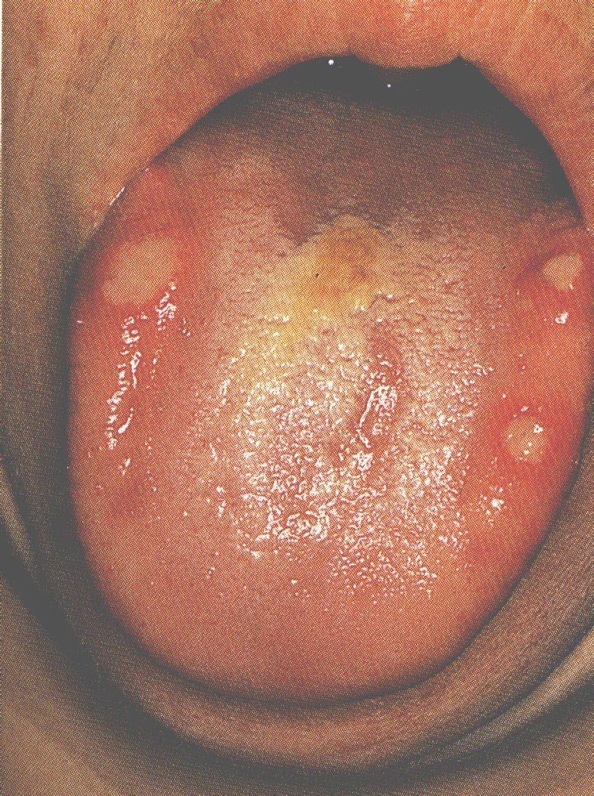 口腔单纯性疱疹图片图片