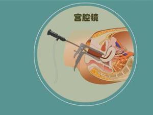 宫腔镜