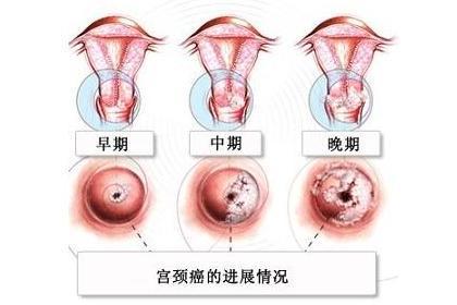 宫颈癌前病变 搜狗百科