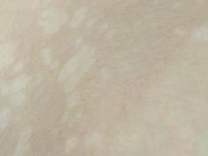 导读:花斑糠疹,旧称花斑癣,俗称汗斑,是由马拉色菌感染表皮角质层引起