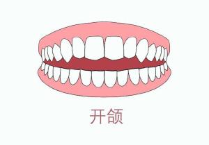 开颌
