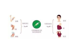 自体移植