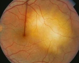 28%～58%的患者出现多种眼部损害,如眼眶炎性假瘤或肿块,巩膜炎,巩膜