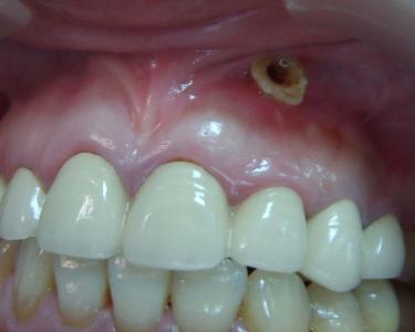 长时间的牙龈血泡就是牙龈瘘管吗