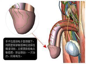 欧式阴茎敏感神经阻断术