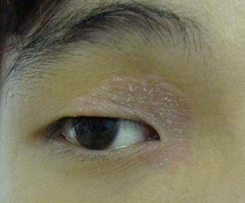 睑皮炎 搜狗百科