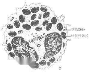 特发性嗜酸性粒细胞增多综合症