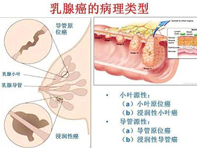 乳腺癌 搜狗百科
