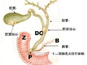 胆总管结石