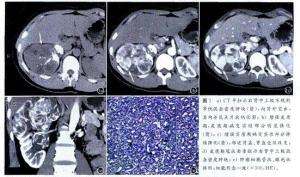 后肾腺瘤CT表现