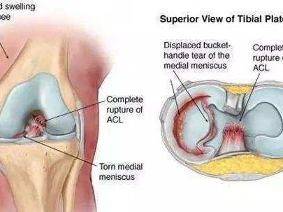 膝关节半月板损伤 搜狗百科