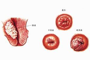 浸润性宫颈癌图片图片