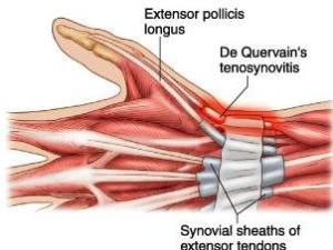 大拇指腱鞘炎