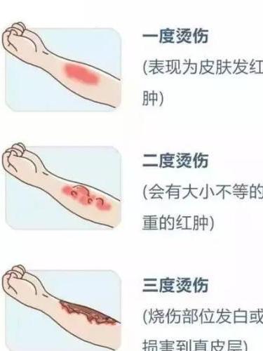 一度烫伤 搜狗百科 一度烫伤 搜狗百科