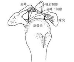 肩部撞击症图解