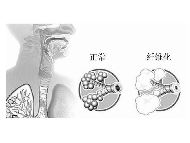 肺纤维化 搜狗百科