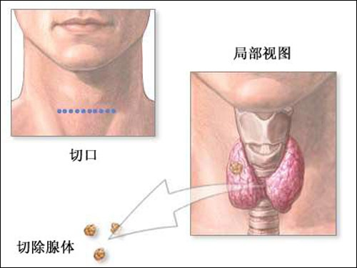 甲状旁腺