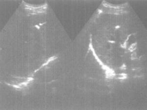 肝内钙化灶声像图