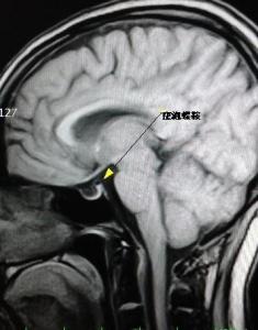 空泡蝶鞍综合征
