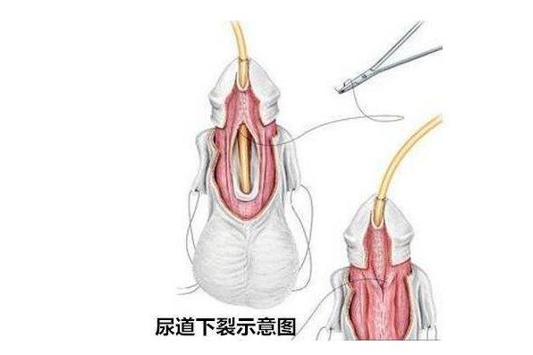 尿道下裂 搜狗百科