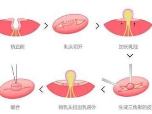 乳头内陷