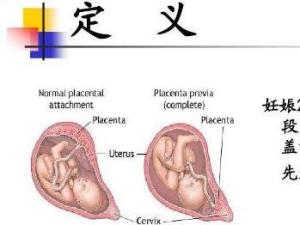 前置胎盘