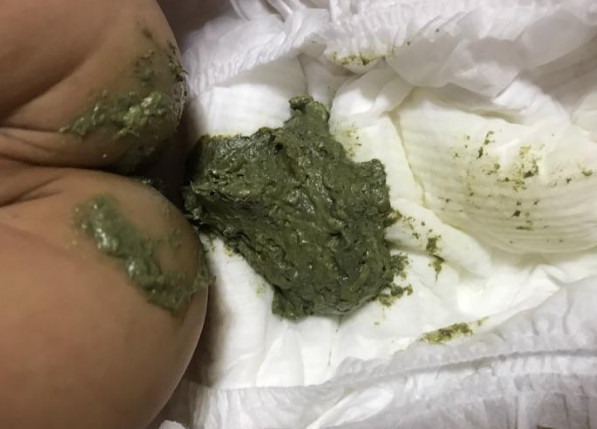 宝宝大便绿色(育儿常识)