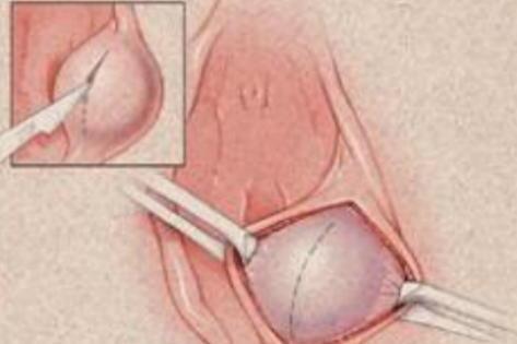 前庭大腺囊肿