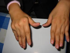 称"行痹"或"周痹"俗称"走注",痹证类型之一.